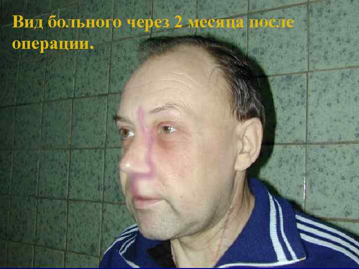 Вид больного через 2 месяца после операции. 