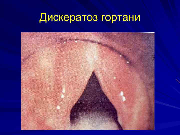 Дискератоз гортани 