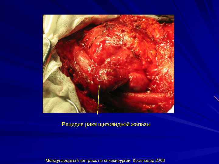 Рецидив рака щитовидной железы Международный конгресс по онкохирургии. Краснодар 2008 