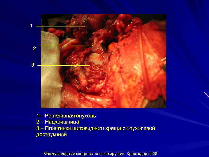 1 2 3 1 – Рецидивная опухоль 2 – Надхрящница 3 – Пластинка щитовидного