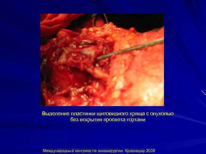 Выделение пластинки щитовидного хряща с опухолью без вскрытия просвета гортани Международный конгресс по онкохирургии.