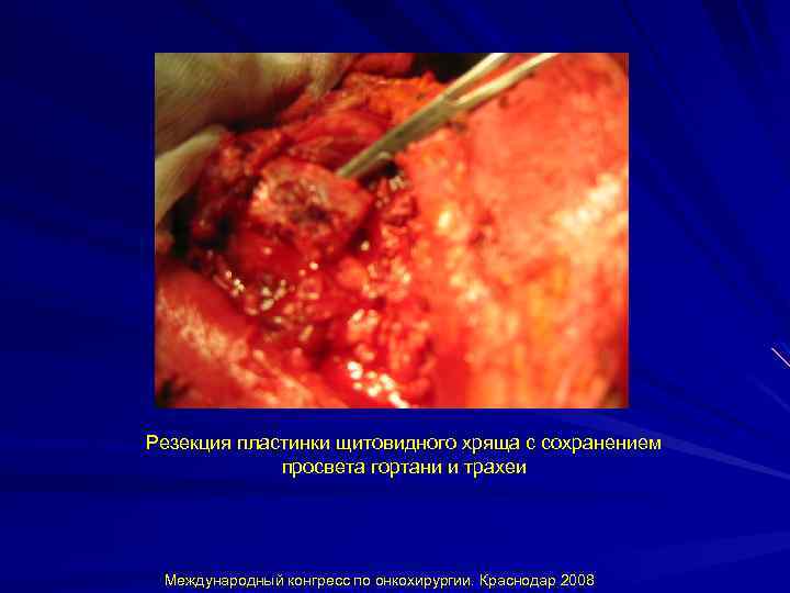 Резекция пластинки щитовидного хряща с сохранением просвета гортани и трахеи Международный конгресс по онкохирургии.
