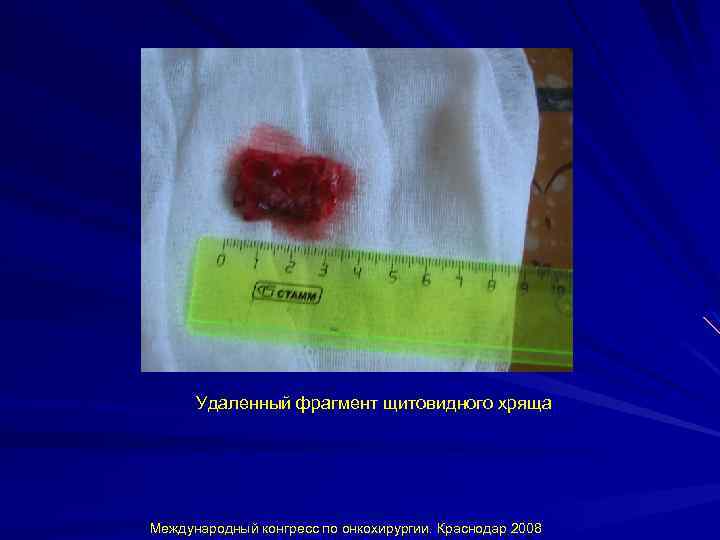 Удаленный фрагмент щитовидного хряща Международный конгресс по онкохирургии. Краснодар 2008 