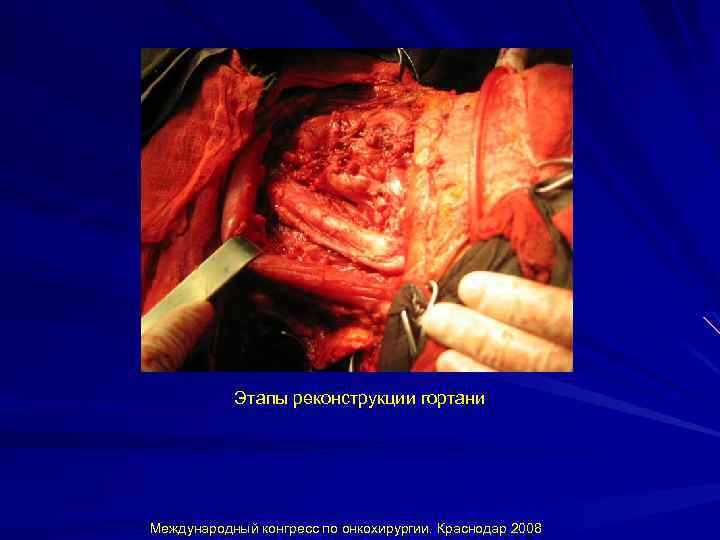 Этапы реконструкции гортани Международный конгресс по онкохирургии. Краснодар 2008 