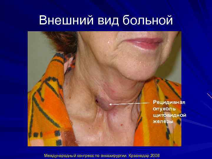 Внешний вид больной Рецидивная опухоль щитовидной железы Международный конгресс по онкохирургии. Краснодар 2008 