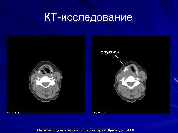 КТ-исследование опухоль Международный конгресс по онкохирургии. Краснодар 2008 