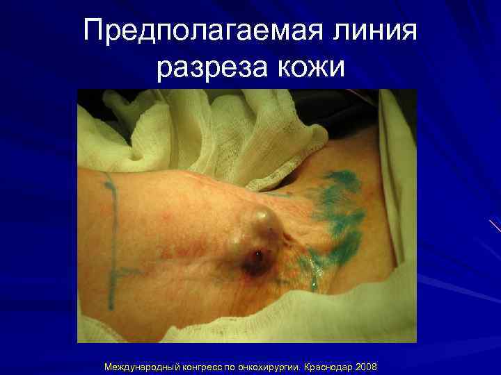 Предполагаемая линия разреза кожи Международный конгресс по онкохирургии. Краснодар 2008 
