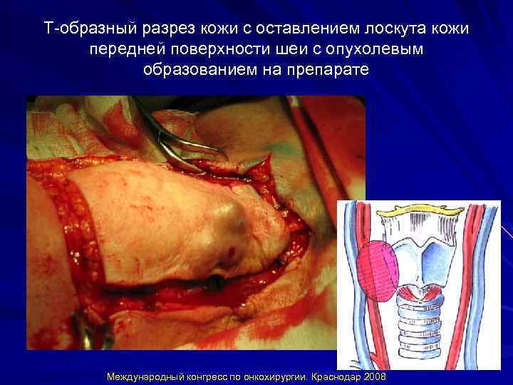 Т-образный разрез кожи с оставлением лоскута кожи передней поверхности шеи с опухолевым образованием на