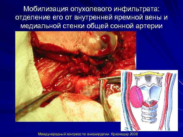 Мобилизация опухолевого инфильтрата: отделение его от внутренней яремной вены и медиальной стенки общей сонной