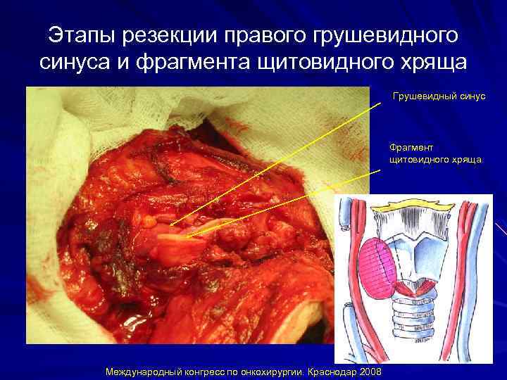 Этапы резекции правого грушевидного синуса и фрагмента щитовидного хряща Грушевидный синус Фрагмент щитовидного хряща