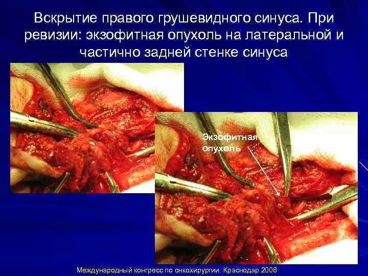 Вскрытие правого грушевидного синуса. При ревизии: экзофитная опухоль на латеральной и частично задней стенке