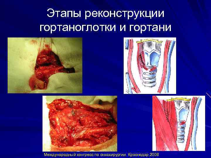 Этапы реконструкции гортаноглотки и гортани Международный конгресс по онкохирургии. Краснодар 2008 