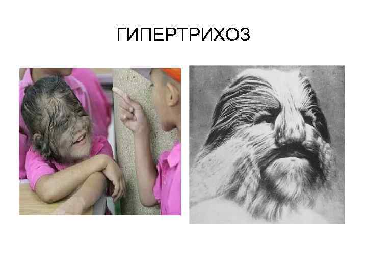 ГИПЕРТРИХОЗ 