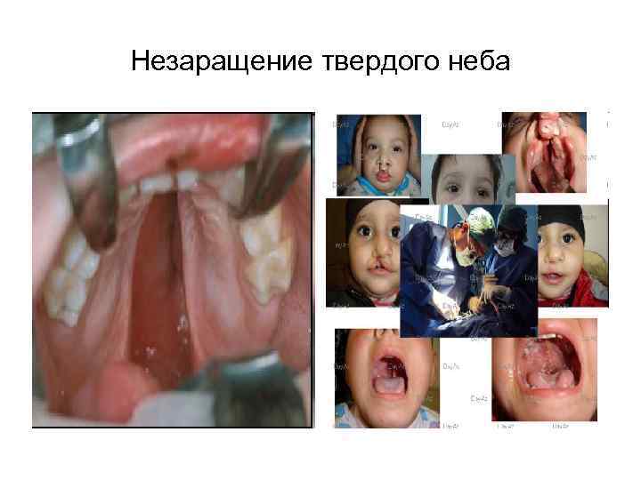 Незаращение твердого неба 