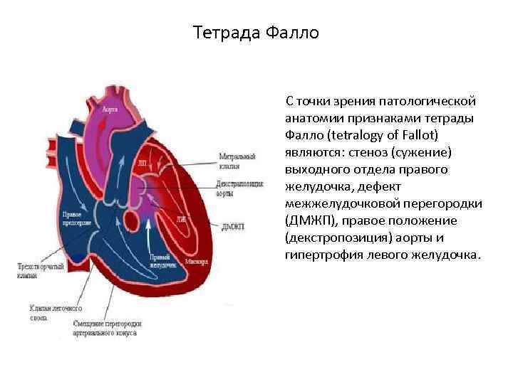 Тетрада фалло картинки