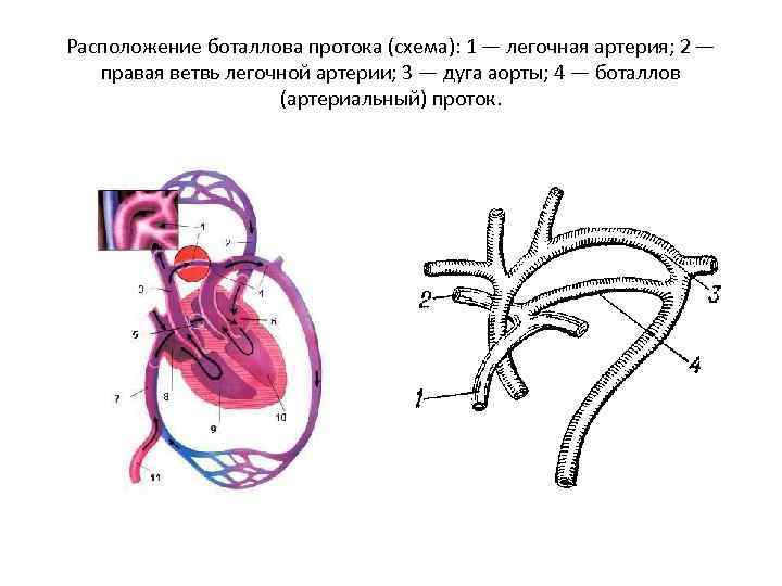 Расположение боталлова протока (схема): 1 — легочная артерия; 2 — правая ветвь легочной артерии;