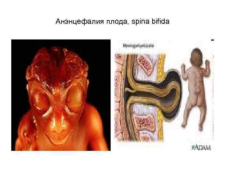 Анэнцефалия плода, spina bifida 