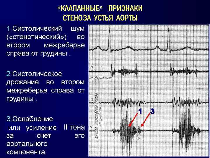  «КЛАПАННЫЕ» ПРИЗНАКИ СТЕНОЗА УСТЬЯ АОРТЫ или усиление 