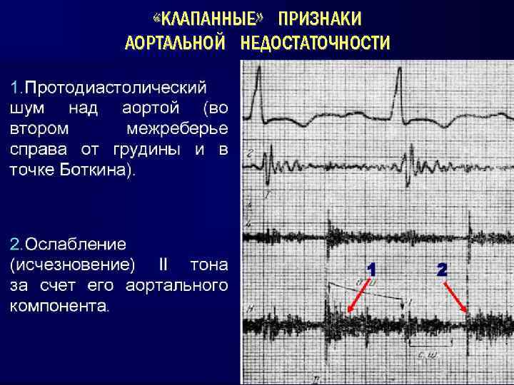  «КЛАПАННЫЕ» ПРИЗНАКИ АОРТАЛЬНОЙ НЕДОСТАТОЧНОСТИ 