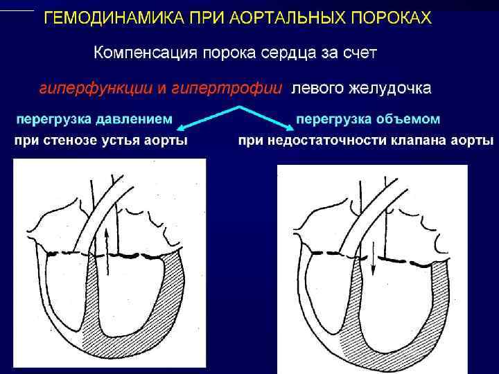 Уплотненные стенки аорты