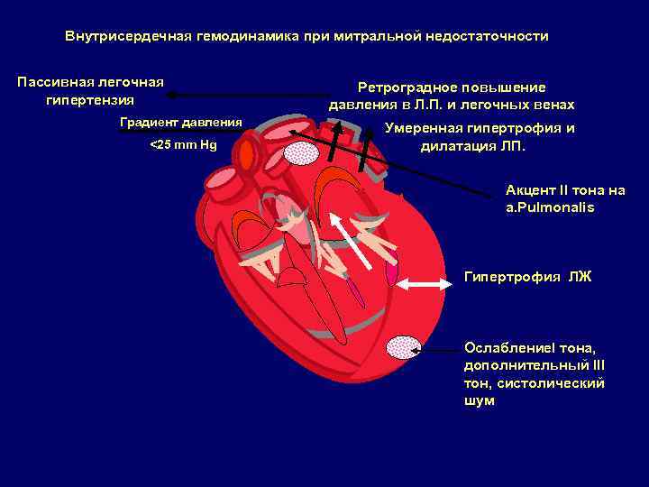Сердечная недостаточность митрального клапана. Митральная недостаточность нарушение гемодинамики. Гемодинамика пороков митральная недостаточность. Порок митрального клапана изменения гемодинамики. Гемодинамика при пороках сердца митральный клапан.