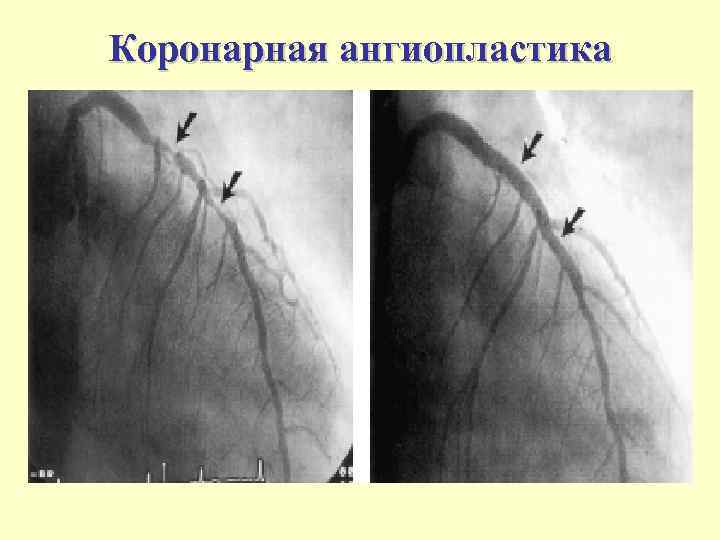 Коронарная ангиопластика 