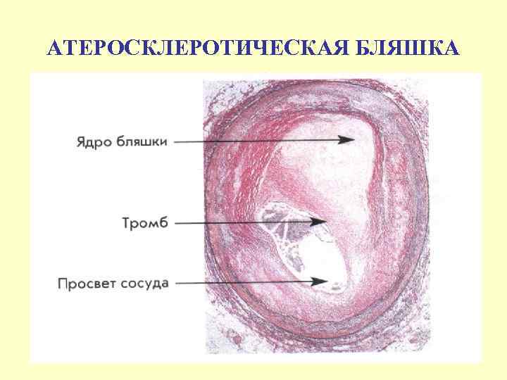 АТЕРОСКЛЕРОТИЧЕСКАЯ БЛЯШКА 