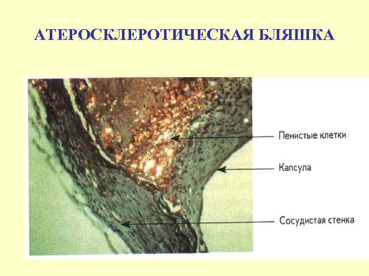 АТЕРОСКЛЕРОТИЧЕСКАЯ БЛЯШКА 