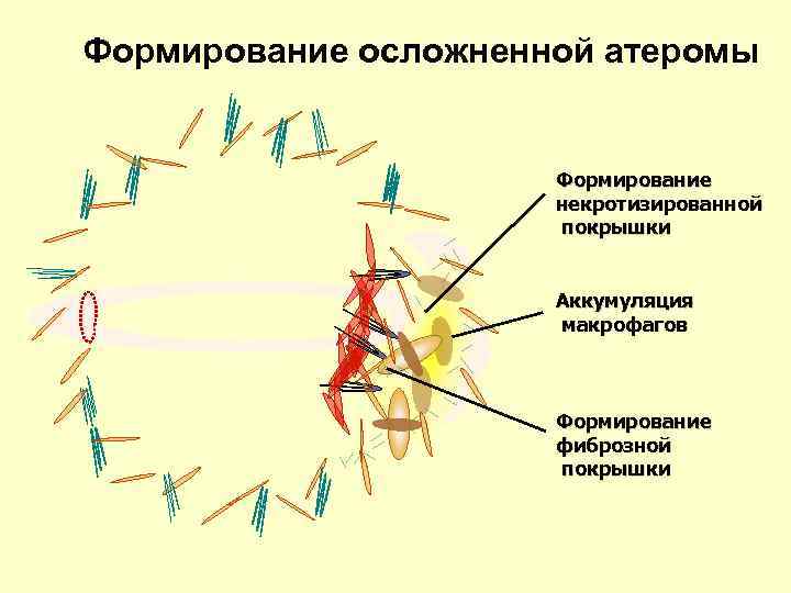 Формирование осложненной атеромы Формирование некротизированной покрышки Аккумуляция макрофагов Формирование фиброзной покрышки 