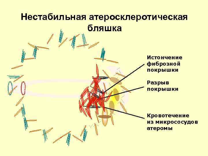 Нестабильная атеросклеротическая бляшка Истончение фиброзной покрышки Разрыв покрышки Кровотечение из микрососудов атеромы 