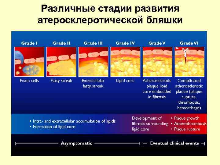 Различные стадии развития атеросклеротической бляшки 