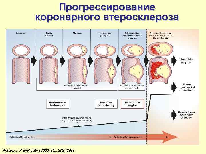 Прогрессирование коронарного атеросклероза Abrams J. N Engl J Med 2005; 352: 2524 -2533 