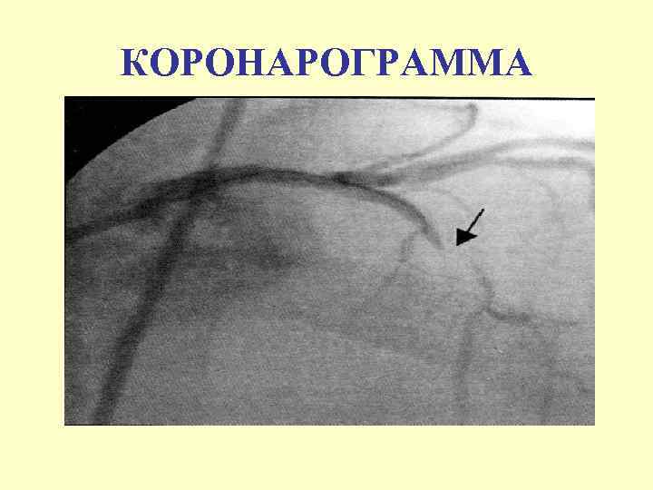 КОРОНАРОГРАММА 