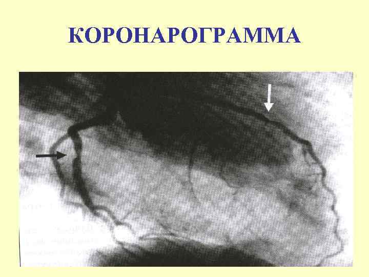 КОРОНАРОГРАММА 