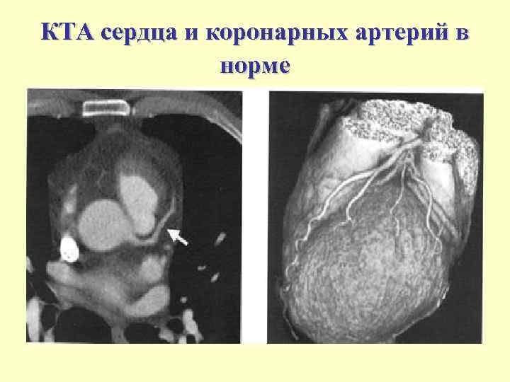 КТА сердца и коронарных артерий в норме 