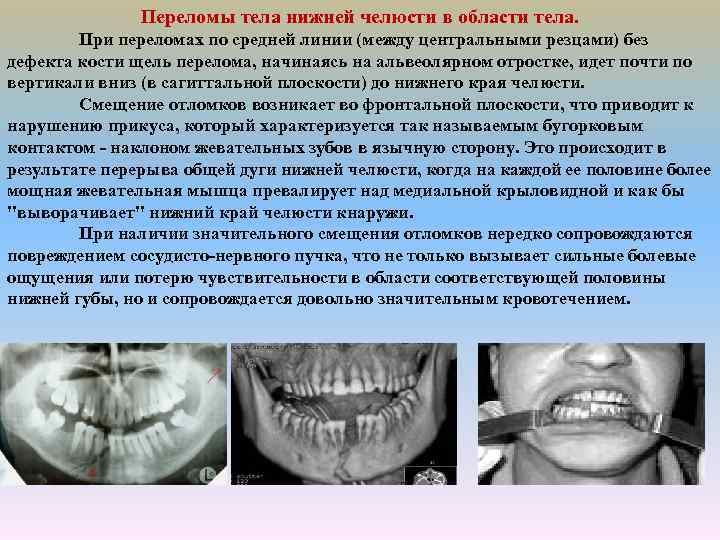 Переломы тела нижней челюсти в области тела. При переломах по средней линии (между центральными