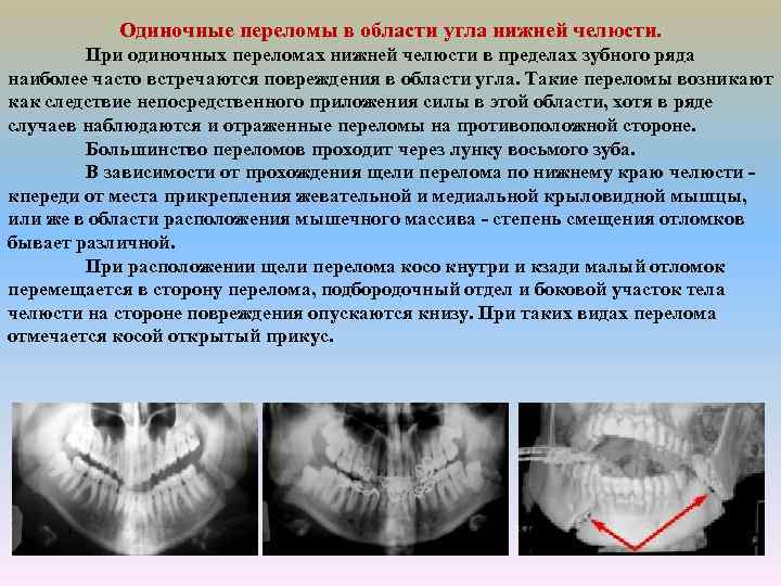 Абсцесс челюстно лицевой области фото