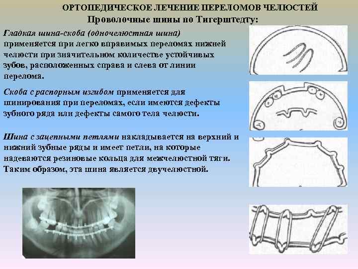 ОРТОПЕДИЧЕСКОЕ ЛЕЧЕНИЕ ПЕРЕЛОМОВ ЧЕЛЮСТЕЙ Проволочные шины по Тигерштедту: Гладкая шина-скоба (одночелюстная шина) применяется при