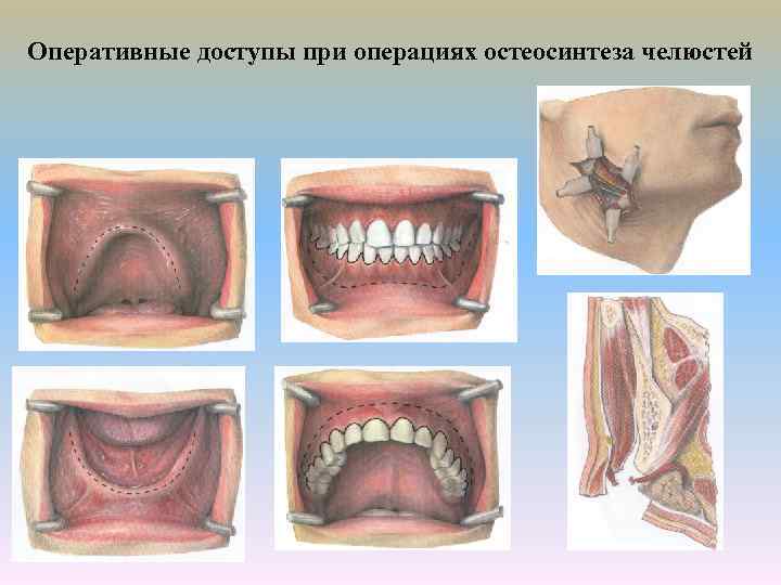 Оперативные доступы при операциях остеосинтеза челюстей 