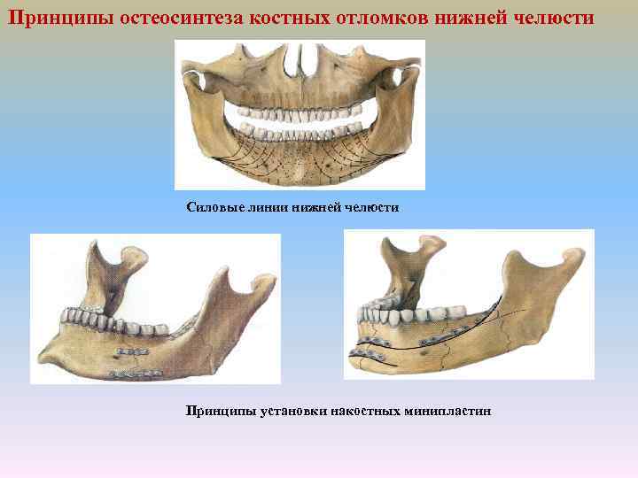 Принципы остеосинтеза костных отломков нижней челюсти Силовые линии нижней челюсти Принципы установки накостных минипластин