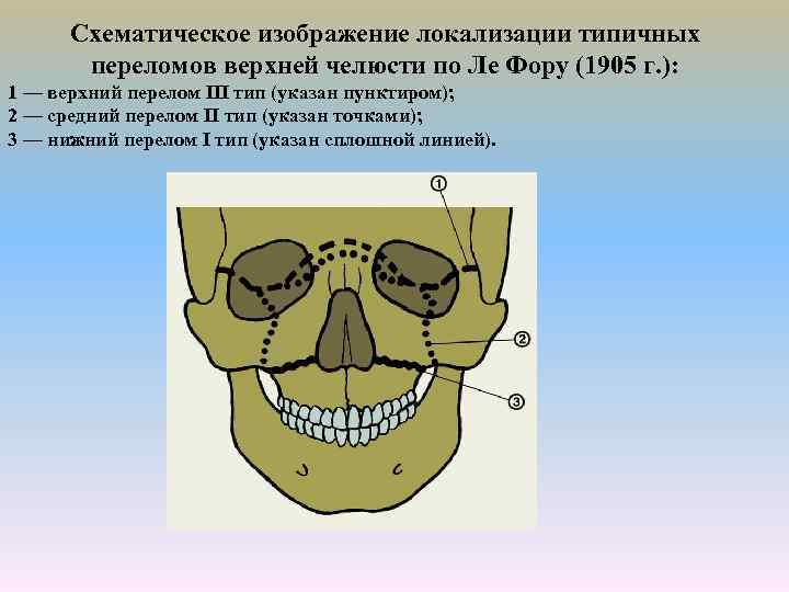 Схематическое изображение локализации типичных переломов верхней челюсти по Ле Фору (1905 г. ): 1