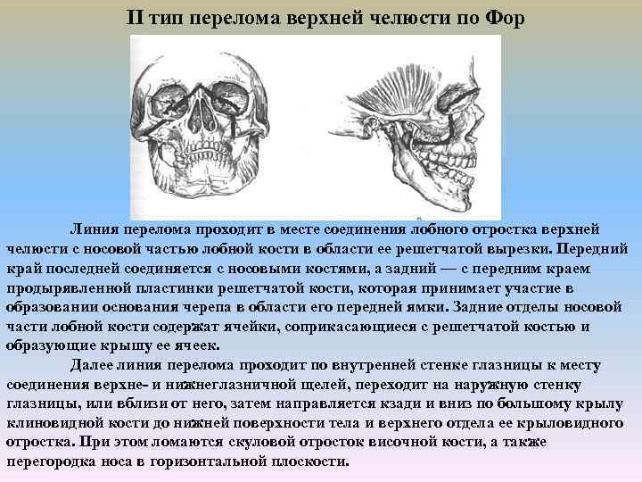 II тип перелома верхней челюсти по Фор Линия перелома проходит в месте соединения лобного