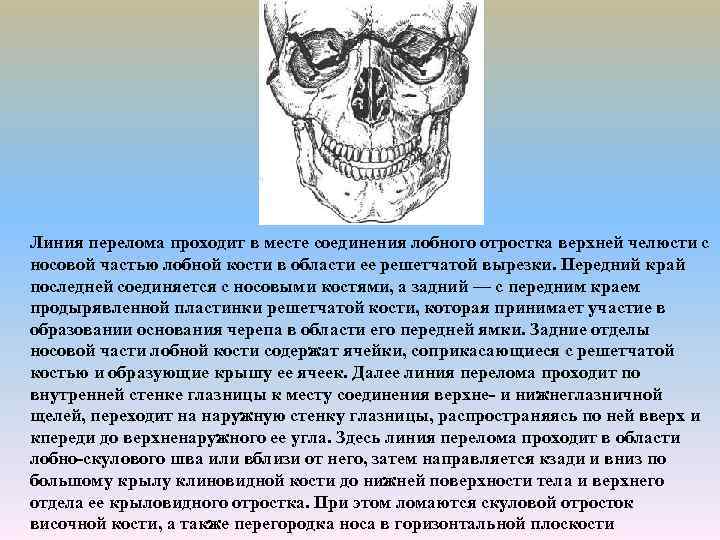 Линия перелома проходит в месте соединения лобного отростка верхней челюсти с носовой частью лобной
