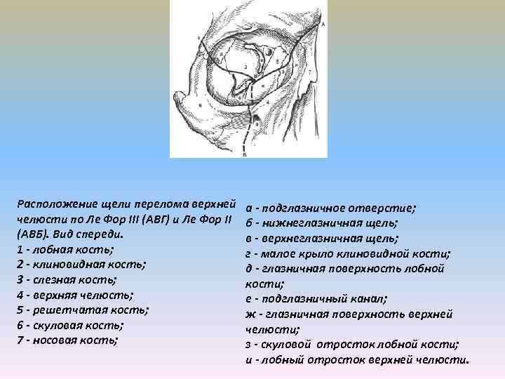 Расположение щели перелома верхней челюсти по Ле Фор III (АВГ) и Ле Фор II