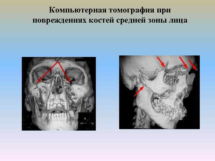 Компьютерная томография при повреждениях костей средней зоны лица 