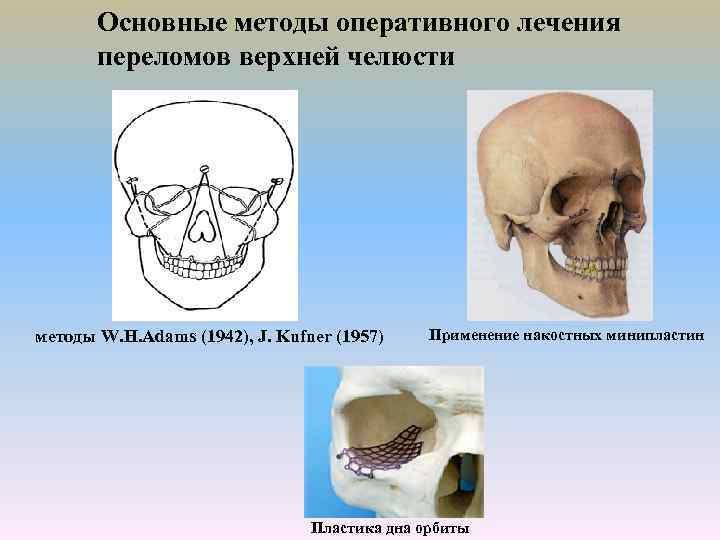 Основные методы оперативного лечения переломов верхней челюсти методы W. H. Adams (1942), J. Kufner