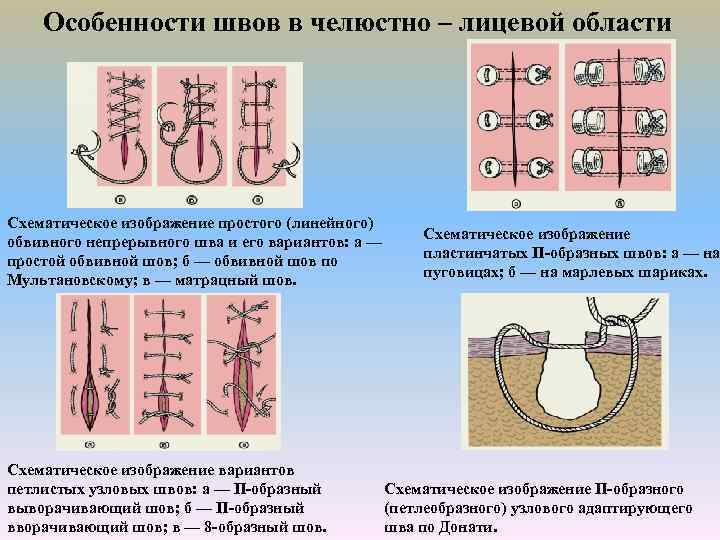 Особенности швов в челюстно – лицевой области Схематическое изображение простого (линейного) обвивного непрерывного шва