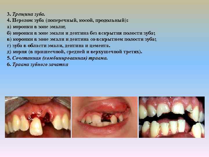 3. Трещина зуба. 4. Перелом зуба (поперечный, косой, продольный): а) коронки в зоне эмали;