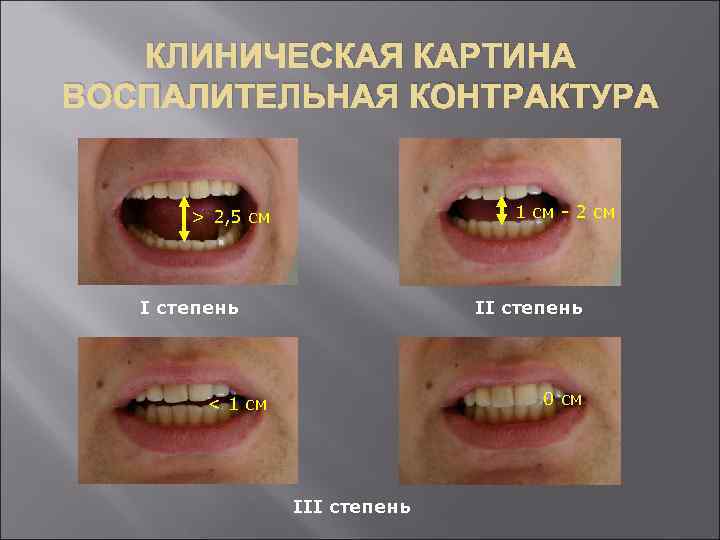 КЛИНИЧЕСКАЯ КАРТИНА ВОСПАЛИТЕЛЬНАЯ КОНТРАКТУРА 1 см - 2 см > 2, 5 см I