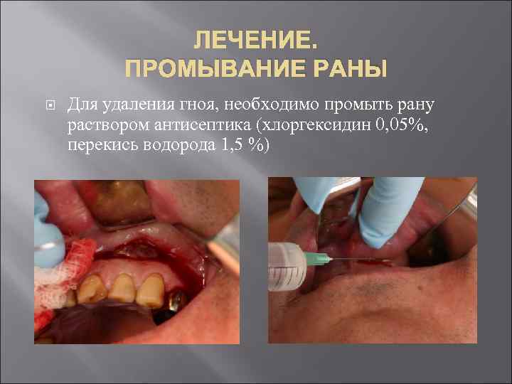 ЛЕЧЕНИЕ. ПРОМЫВАНИЕ РАНЫ Для удаления гноя, необходимо промыть рану раствором антисептика (хлоргексидин 0, 05%,